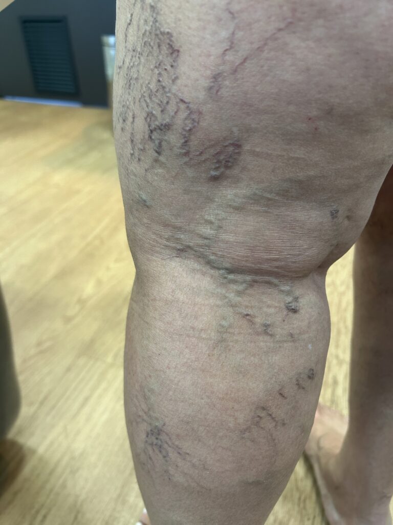 Descubra os Riscos de Não Tratar Varizes